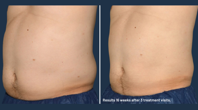 Coolsculpting elite before and after
